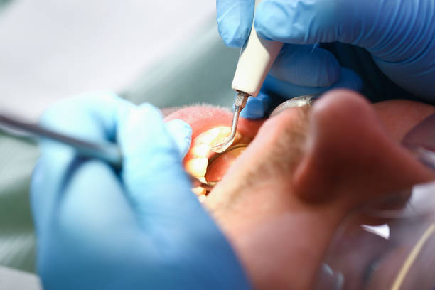 Best Emergency Tooth Extraction in Glen Gardner, NJ
